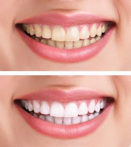 Teeth Whitening San Leandro, CA